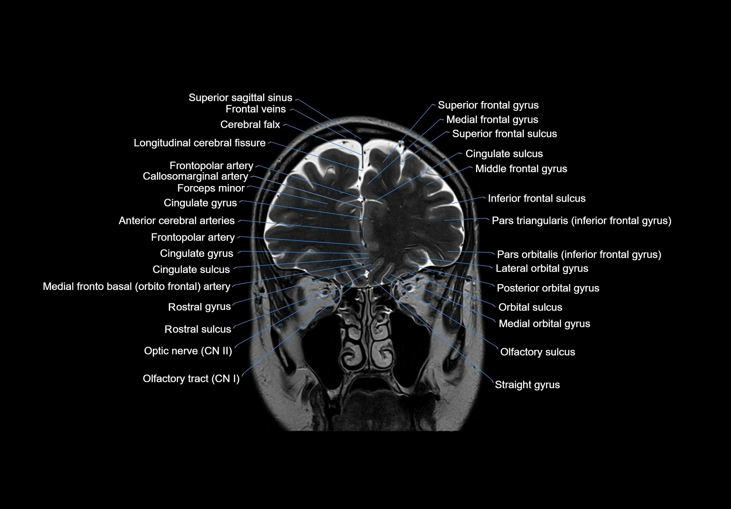 MRI Brain coronal cross sectional labelled anatomy 3T image  -img-00001-00019.webp